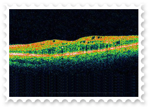 RETINA HOSPITAL